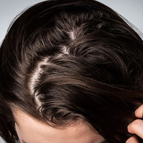 Cabello graso